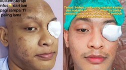 Kisah Tragis Seorang Pria Medan Menghadapi Kanker dan Kehilangan Bola Mata