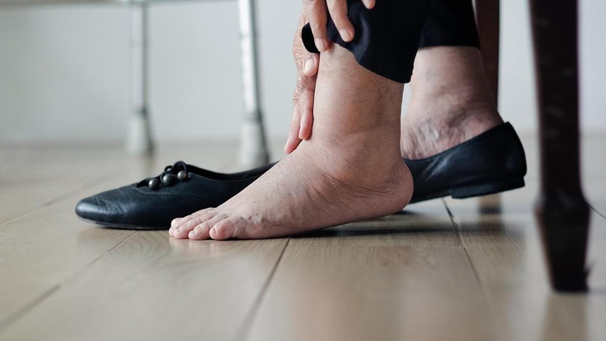 Waspadai Tanda-Tanda Kerusakan Ginjal yang Terlihat di Kaki Anda