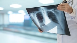 Hubungan Antara Penyakit Campak dan Pneumonia yang Mengancam Kesehatan Paru-paru
