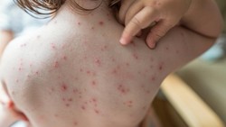 Strategi Kemenkes untuk Melindungi Anak dari Campak Melalui Imunisasi dan Pengetahuan