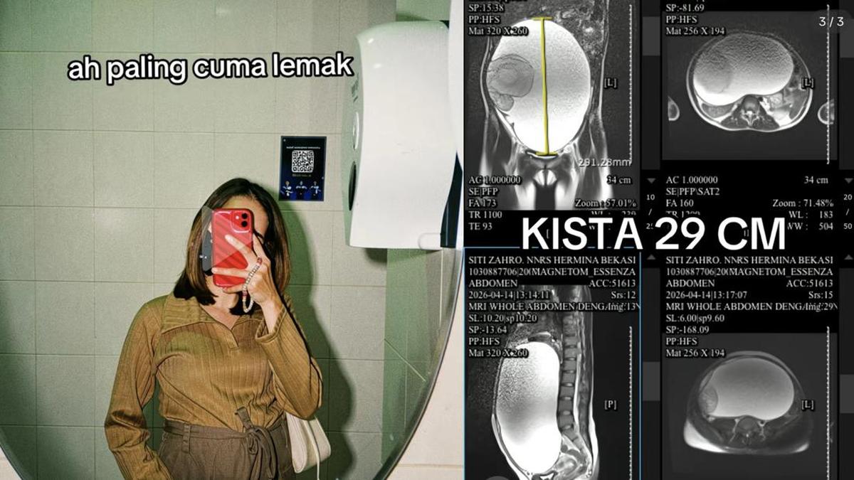Kisah Siti Zahro: Wanita Bekasi Berjuang Melawan Kista Ovarium Seberat 29 Cm